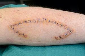 Similar wound at 3 weeks immediately prior to suture removal.