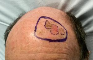 A diffuse area of pre-invasive melanoma and planned excision.