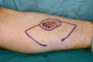 The planned excision and modified keystone flap repair of an early melanoma on the lower leg has been planned.