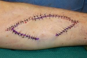 Sutured wound at the end of the surgery.