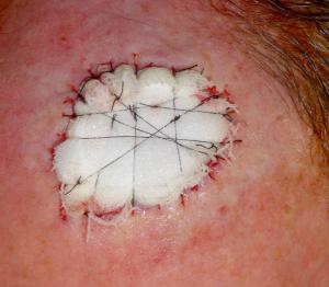Skin graft has been secured beneath a foam pack to immobilise it against the excision defect.