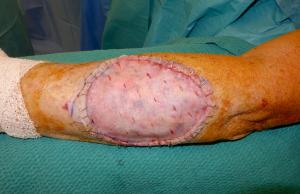 A sheet of split thickness skin has been harvested throw the patient's thigh and sutured securely into the excision defect.