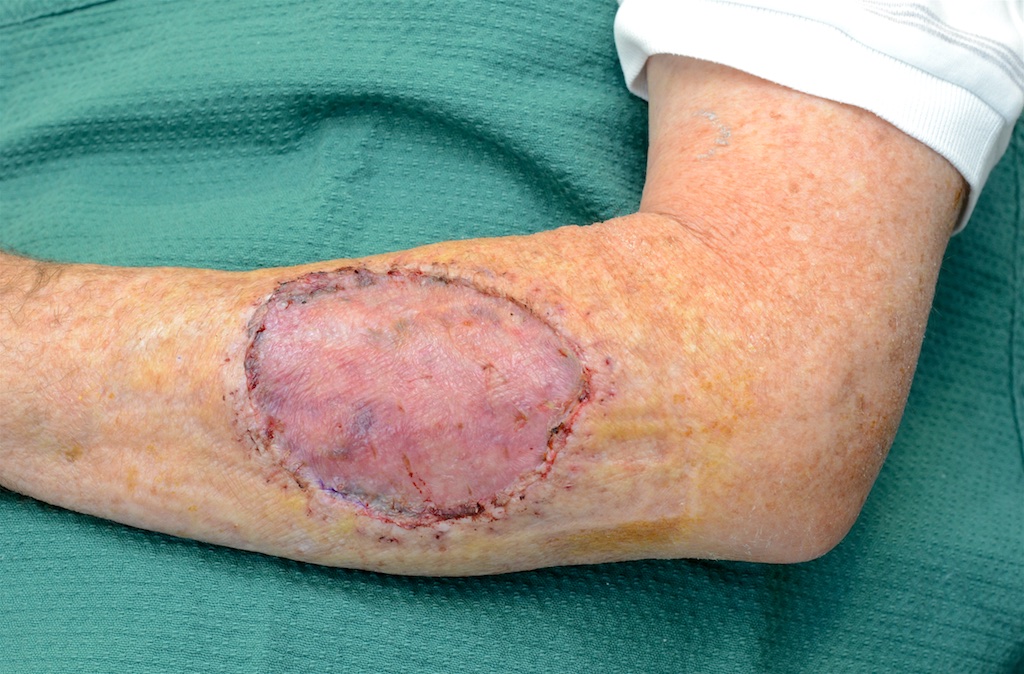 Skin Graft Donor Area (Thigh) Photos After Surgery - Arm Scars