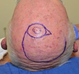 The pre-invasive melanoma is delineated by the dotted outline. The planned excision and flap repair is drawn.
